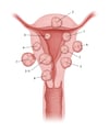 Système de sous-classification PALM-COEIN* du léiomyome utérin (fibrome)