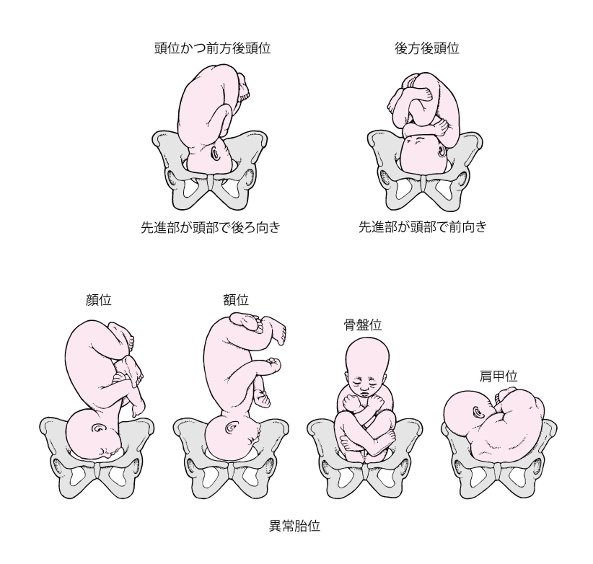 先進部,胎向,および胎位(骨盤位を含む) - 18. 婦人科および産科 - MSDマニュアル プロフェッショナル版