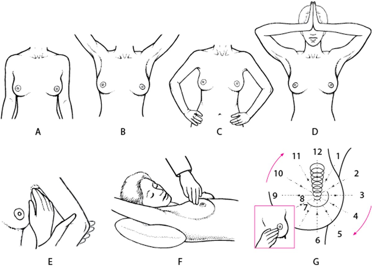 乳腺检查