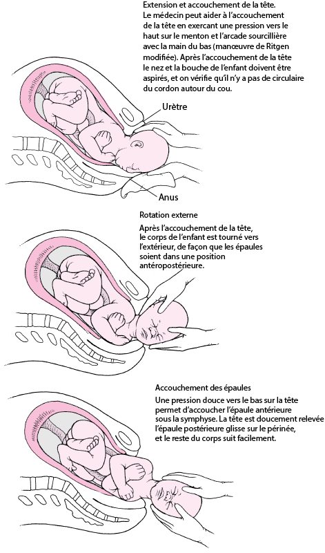 Prise en charge de l'accouchement vaginal spontané - Gynécologie et ...