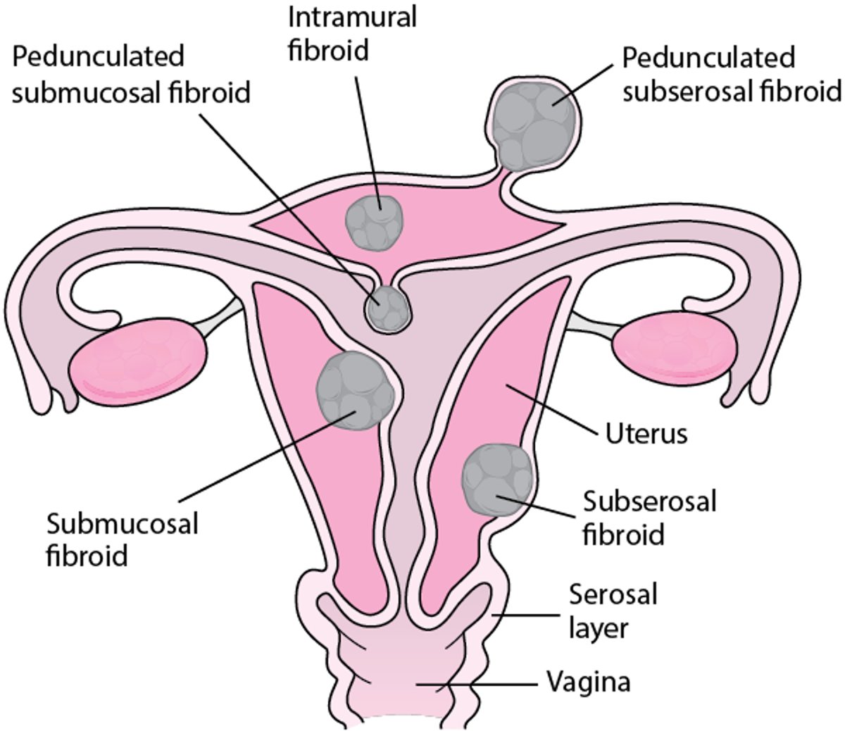 Anatomische Lage der Uterusmyome