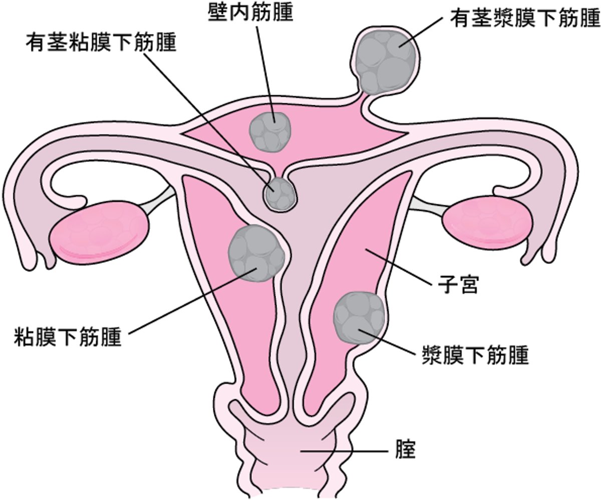 子宮筋腫の解剖学的位置