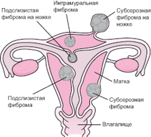 Анатомические локализации миомы матки