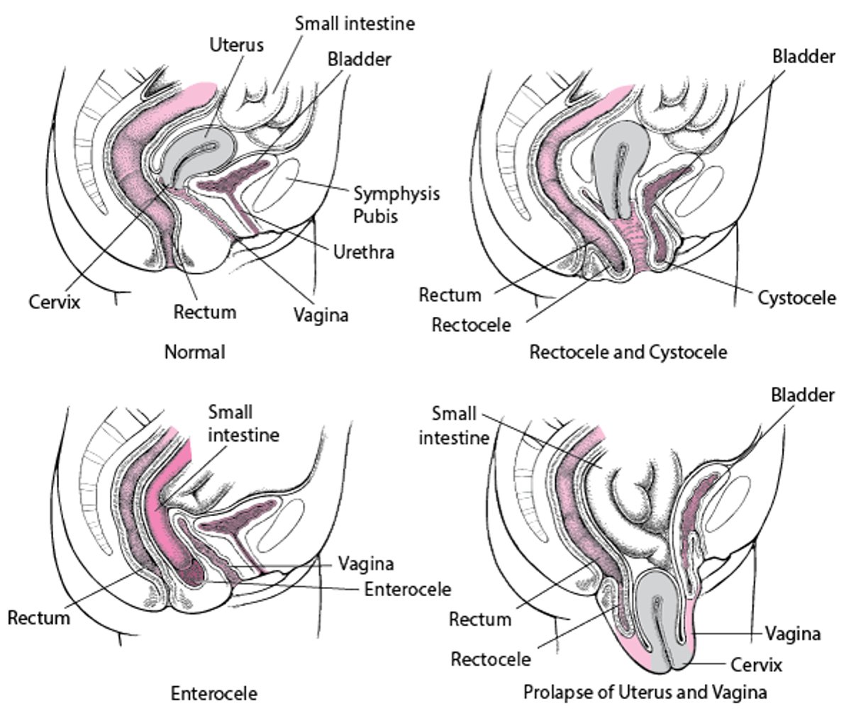 Pelvic Organ Prolapse