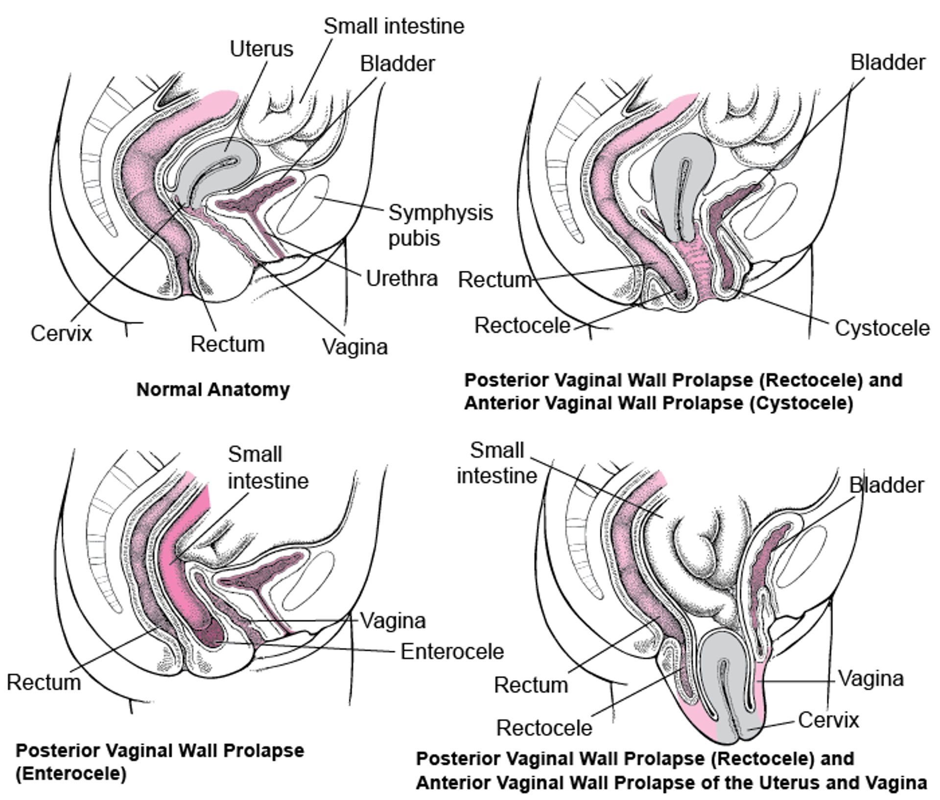 Pelvic Organ Prolapse