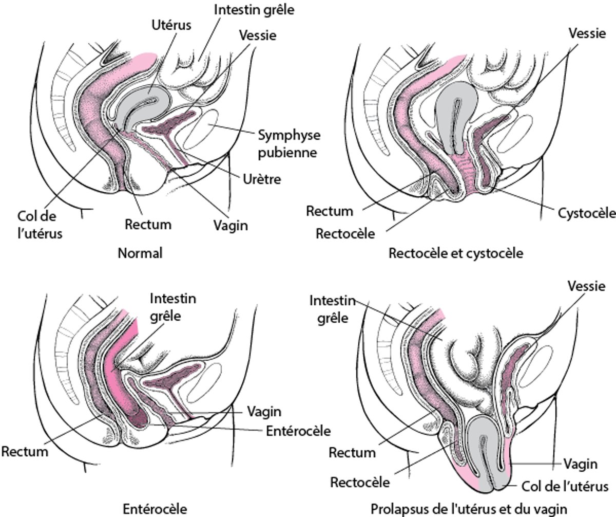 Prolapsus des organes pelviens