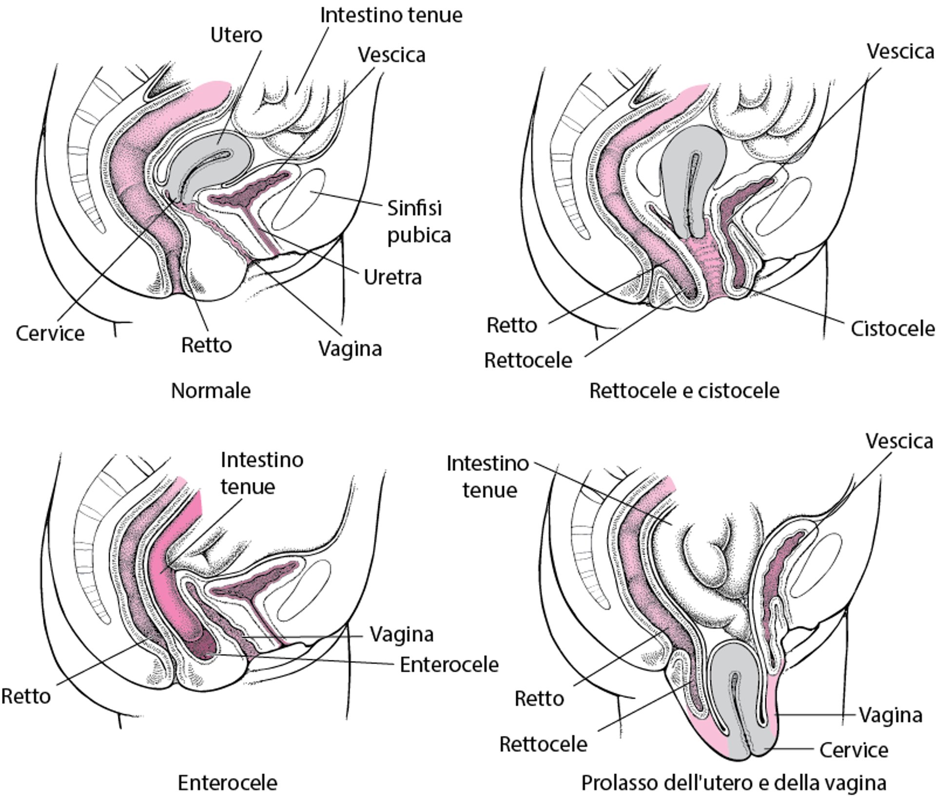 Prolasso degli organi pelvici