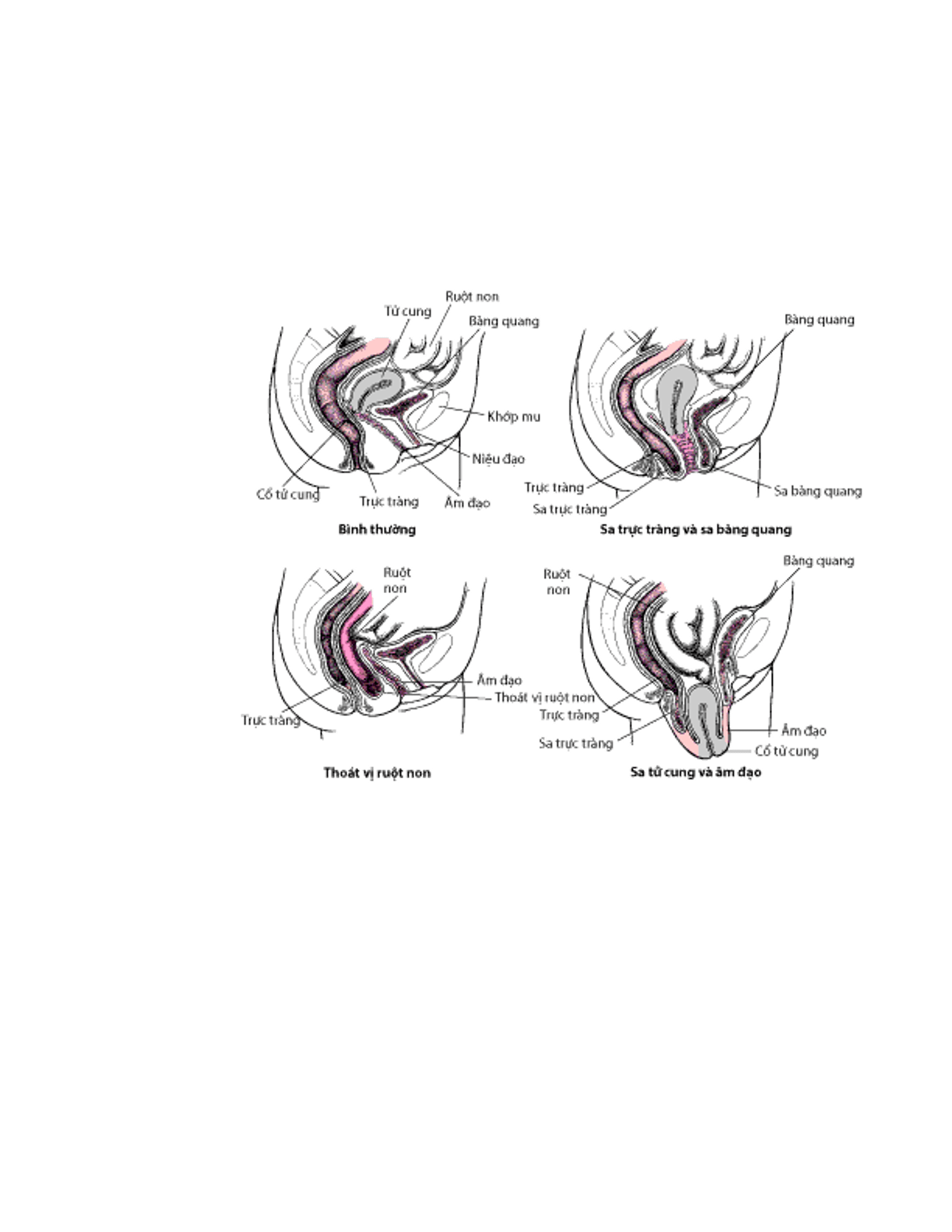 Pelvic Organ Prolapse