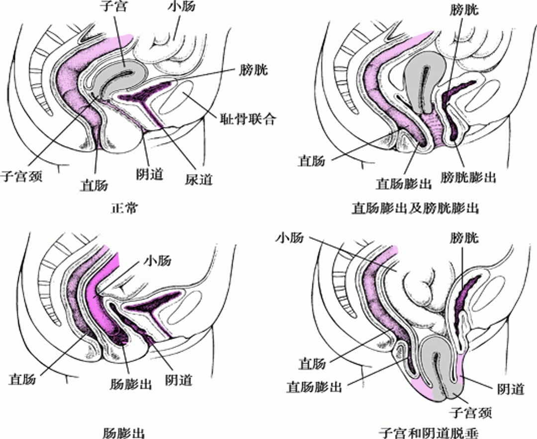 盆腔器官脱垂