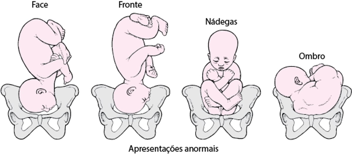 Posição e apresentação do feto