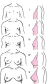 Diagrammatic Representation of Sexual Maturity Rating (Tanner) Stages I to V of Breast Maturation in Girls
