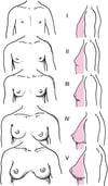 Schematische Darstellung der Sexualreife-Bewertung (Tanner) Stadien I bis V der Brustreife bei Mädchen
