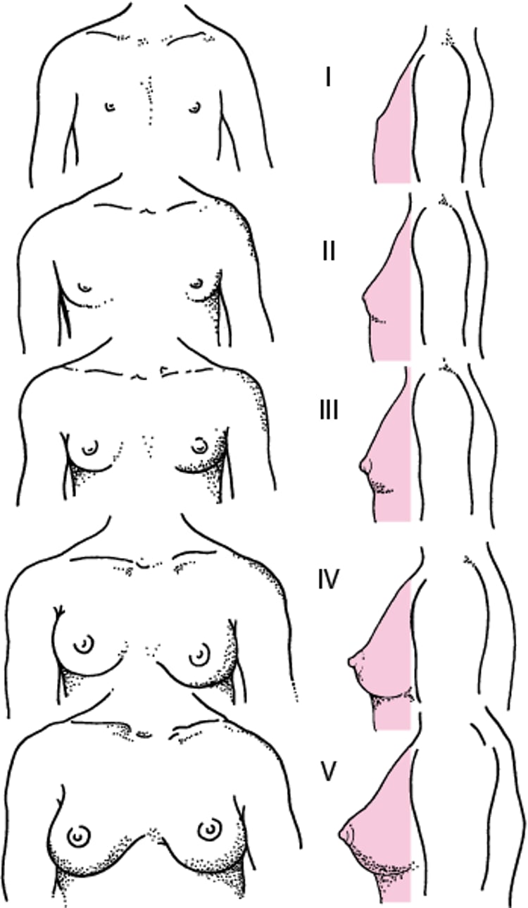 Schematische Darstellung der Sexualreife-Bewertung (Tanner) Stadien I bis V der Brustreife bei Mädchen