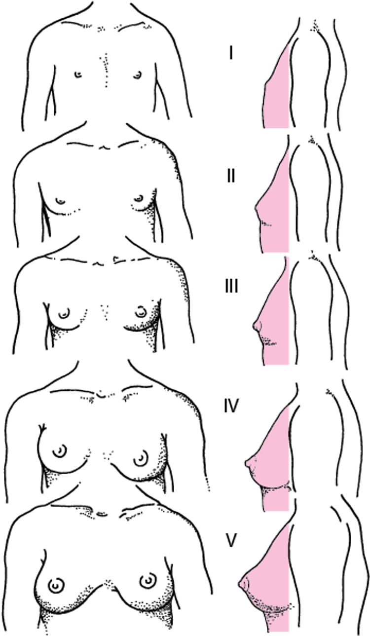 Representación diagramática de las etapas I a V de la escala de madurez sexual (Tanner) de la maduración mamaria en niñas