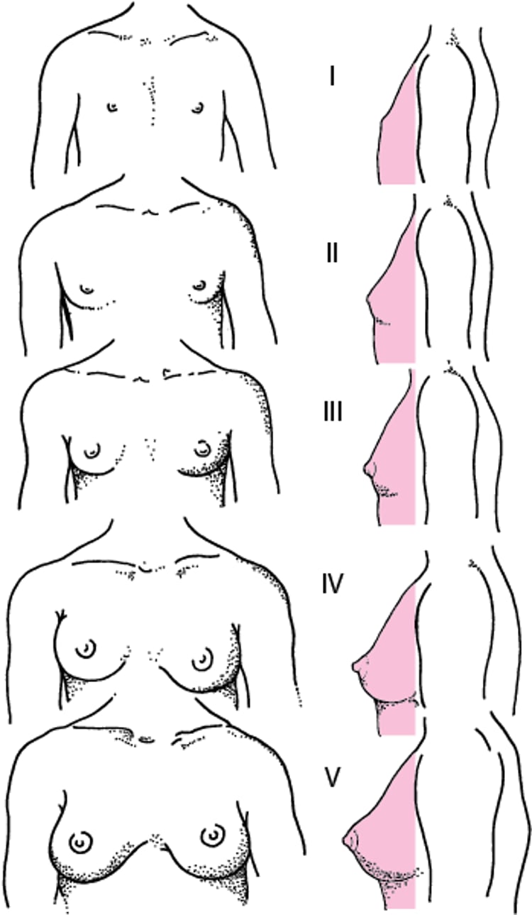 Representación de los estadios I a V de Tanner de la maduración mamaria humana en niñas
