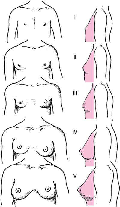 Représentation schématique des stades de Tanner I à V de la maturation du sein chez la jeune fille