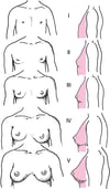 Rappresentazione schematica degli stadi di maturazione sessuale della mammella (Tanner) da I a V nelle ragazze