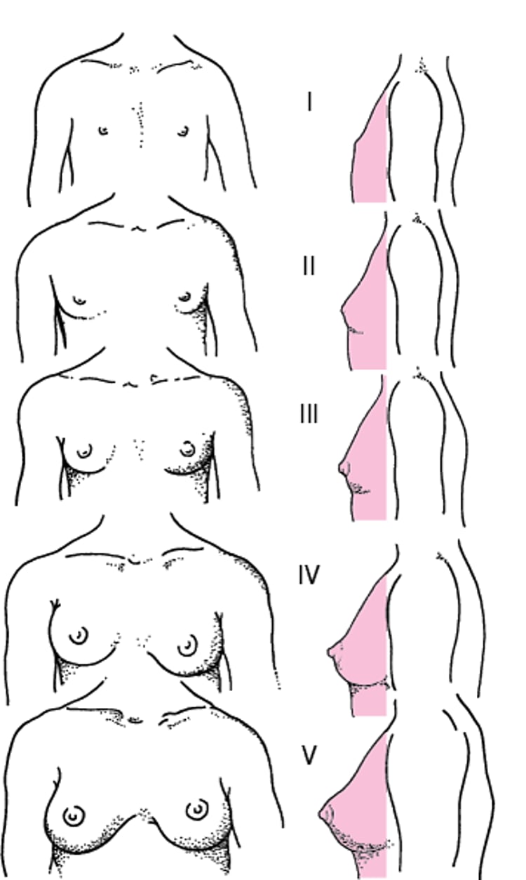 女児の乳房成熟に関する性的成熟度（タナー段階I～V）の模式図