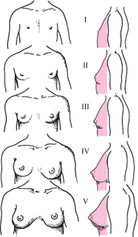 女児の乳房成熟に関するタナー段階（I～V）の模式図