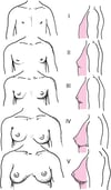 Representação esquemática dos estágios de maturidade sexual (Tanner) I a V para a maturação mamária em meninas