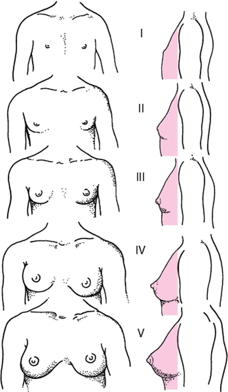 Representação esquemática dos estágios de maturidade sexual (Tanner) I a V para a maturação mamária em meninas