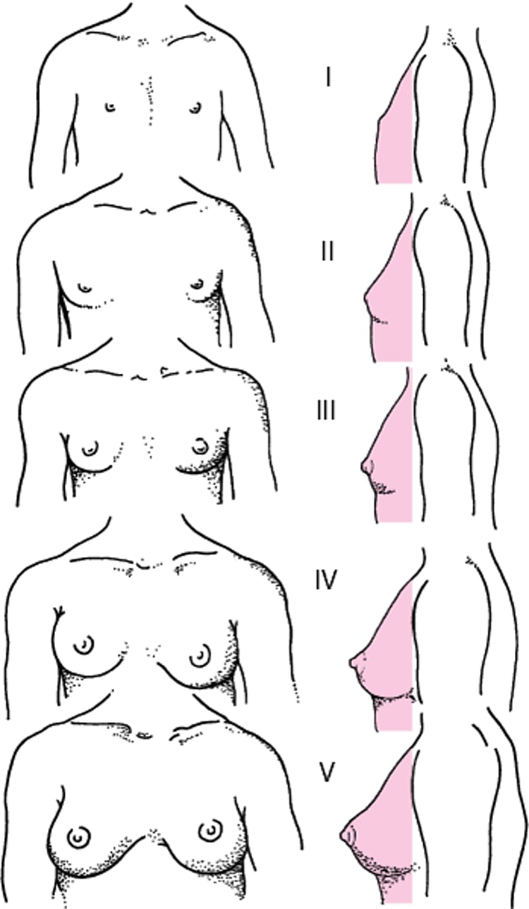 Representação diagramática dos estágios I a V de Tanner para o desenvolvimento das mamas em meninas
