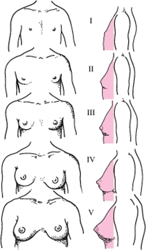 Схематическое изображение стадий I-V созревания молочных желез по Таннеру у девочек