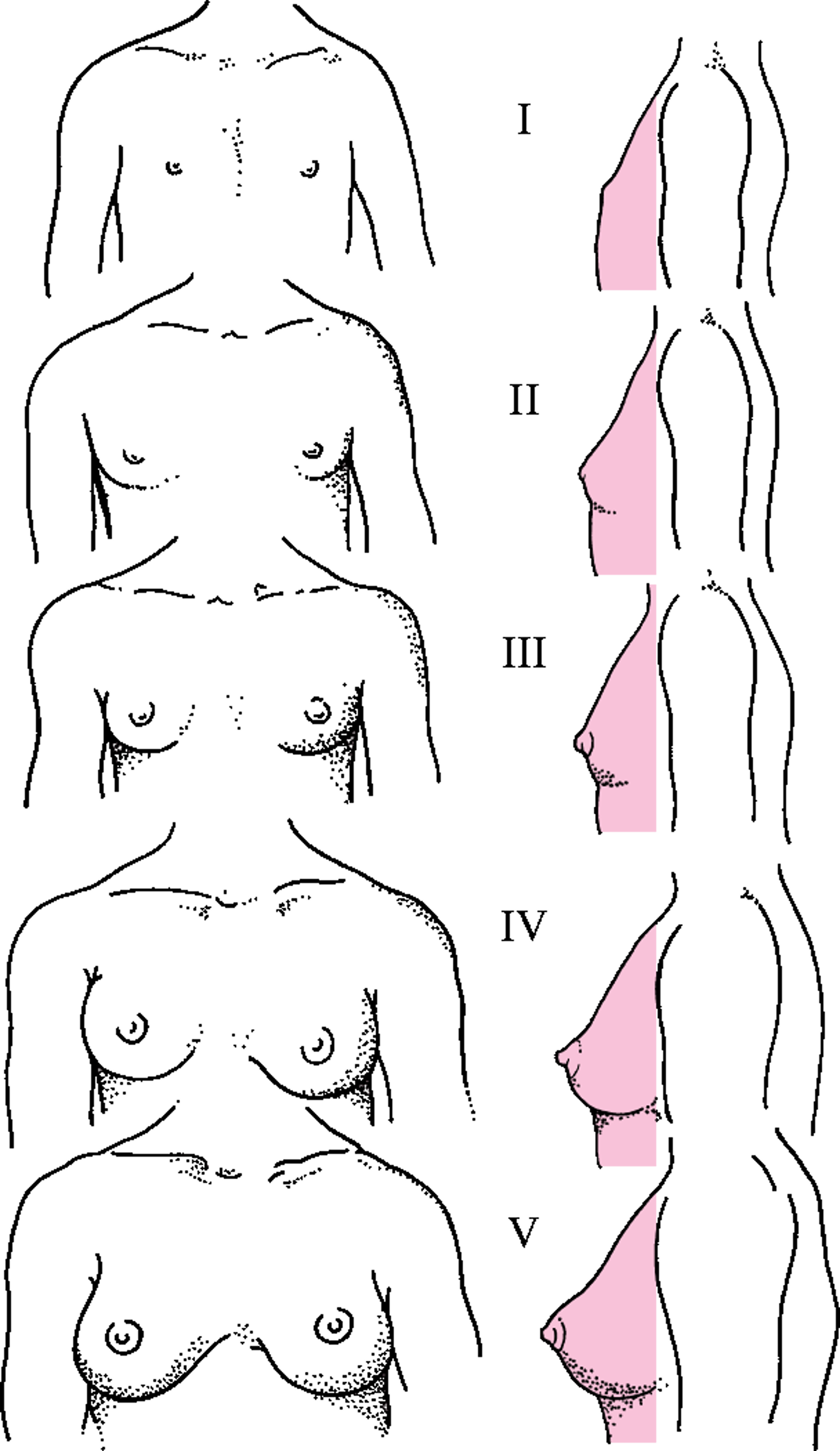 Biểu đồ mô tả các giai đoạn Tanner từ I đến V đối với sự phát triển tuyến vú.