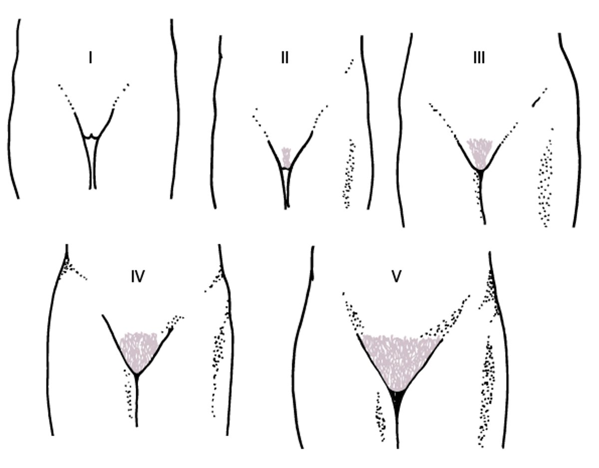 Diagrammatic Representation of Sexual Maturity Rating (Tanner) Stages I to V for Development of Pubic Hair in Girls