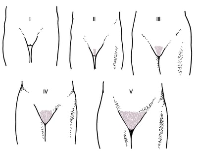Diagrammatic Representation of Sexual Maturity Rating (Tanner) Stages I to V for Development of Pubic Hair in Girls