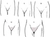 Schematische Darstellung der Sexual Maturity Rating (Tanner) Stadien I bis V für die Entwicklung der Schambehaarung bei Mädchen