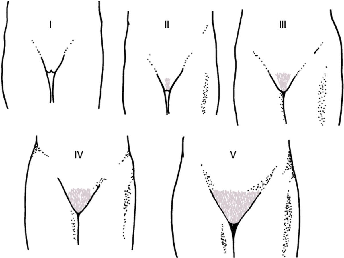 Schematische Darstellung der Sexual Maturity Rating (Tanner) Stadien I bis V für die Entwicklung der Schambehaarung bei Mädchen