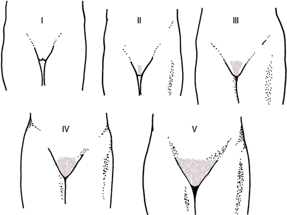 Schematische Darstellung der Stadien I–V nach Tanner für die Entwicklung der Schambehaarung bei Mädchen
