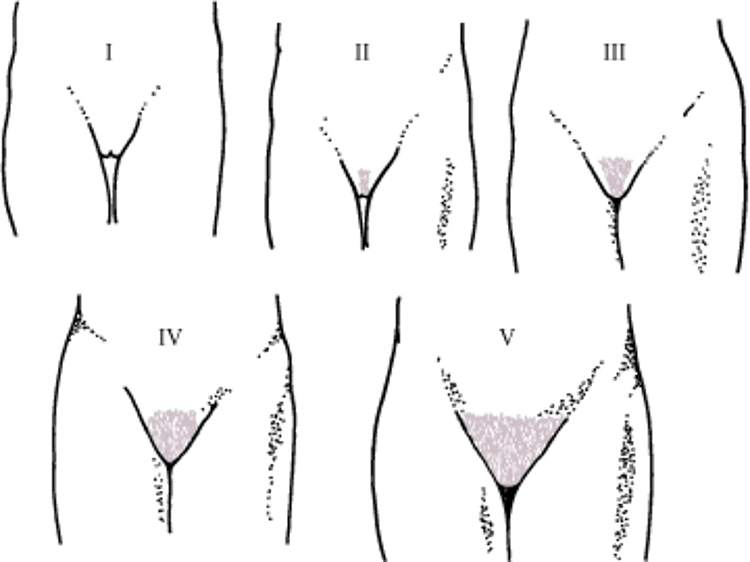 女児の陰毛発達に関するタナー段階（I～V）の模式図