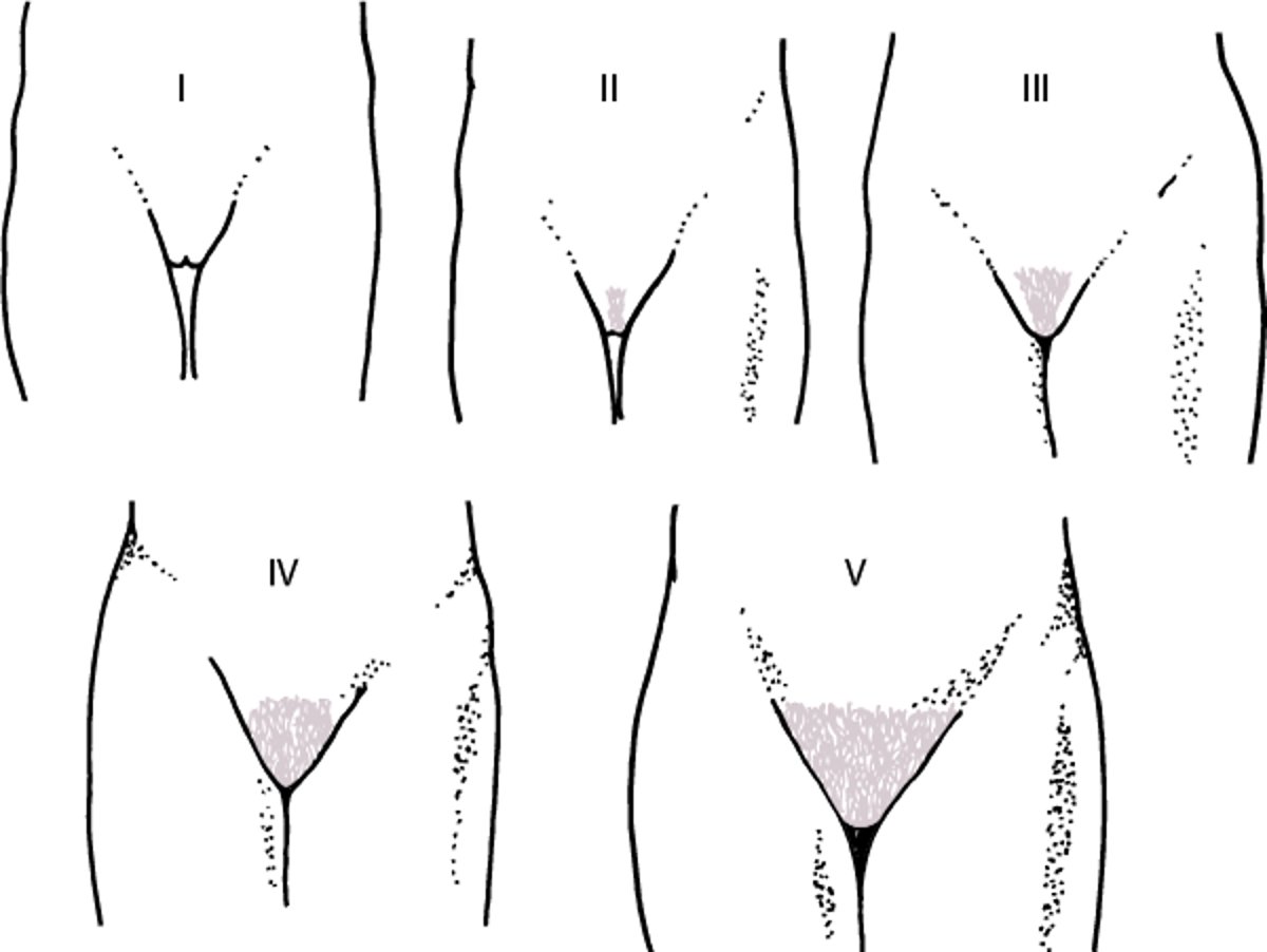Representação esquemática dos estágios de maturidade sexual (Tanner) I a V para o desenvolvimento de pelos pubianos em meninas
