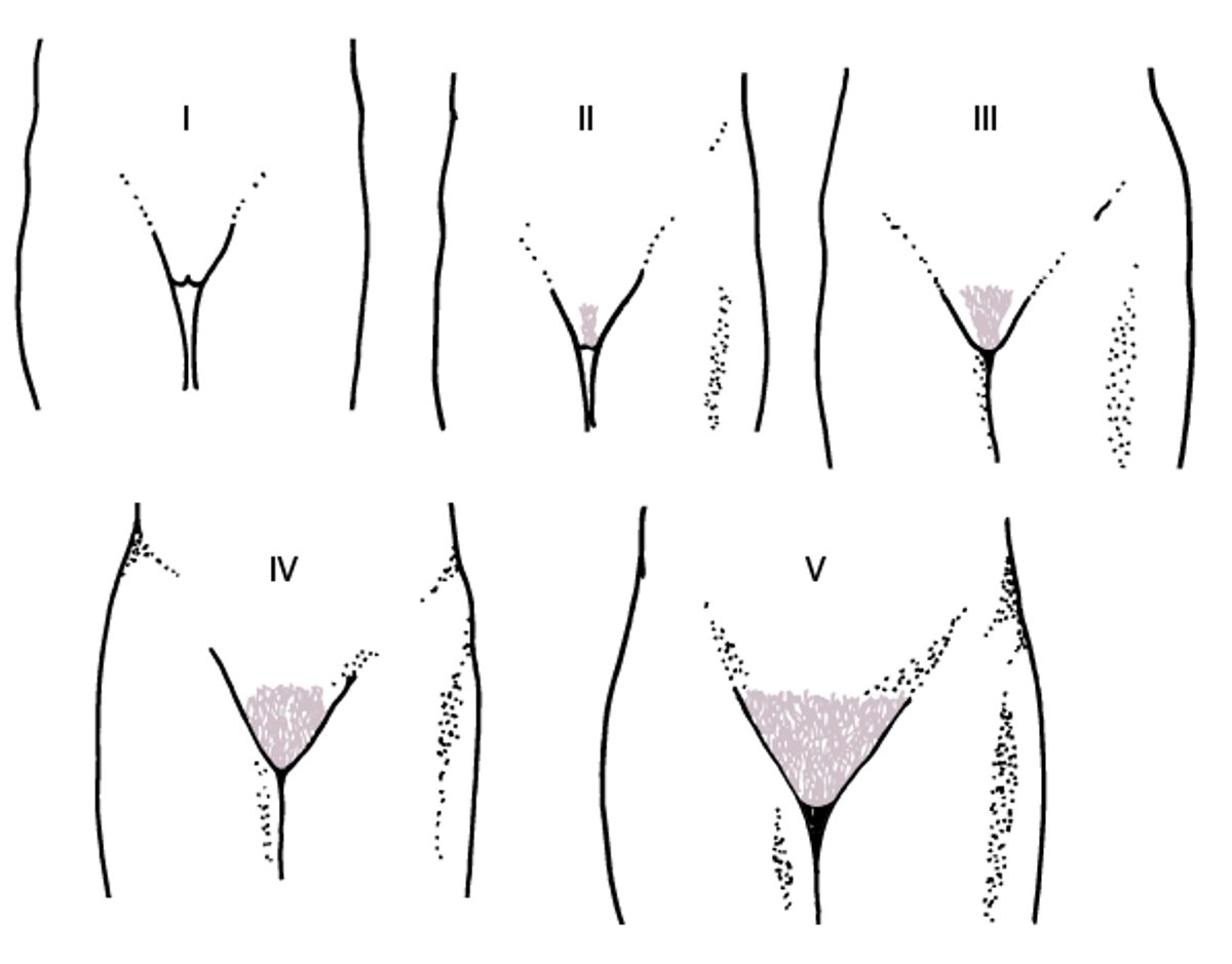 Схематичне зображення стадій Таннера від I до V для розвитку лобкового волосся у дівчат