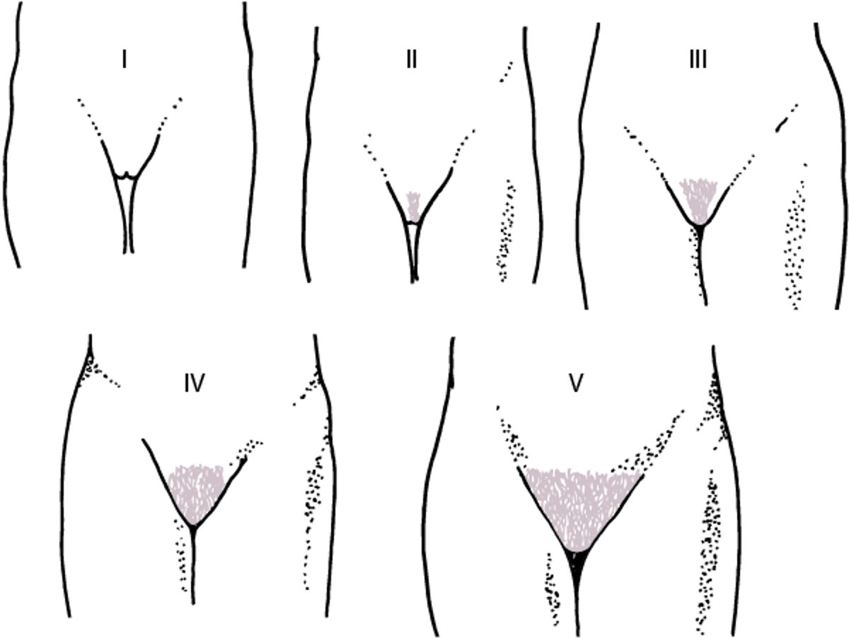 女孩阴毛发育性成熟度 (Tanner) I-V 期的图解表示