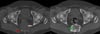 Riesenzelltumor (CT)
