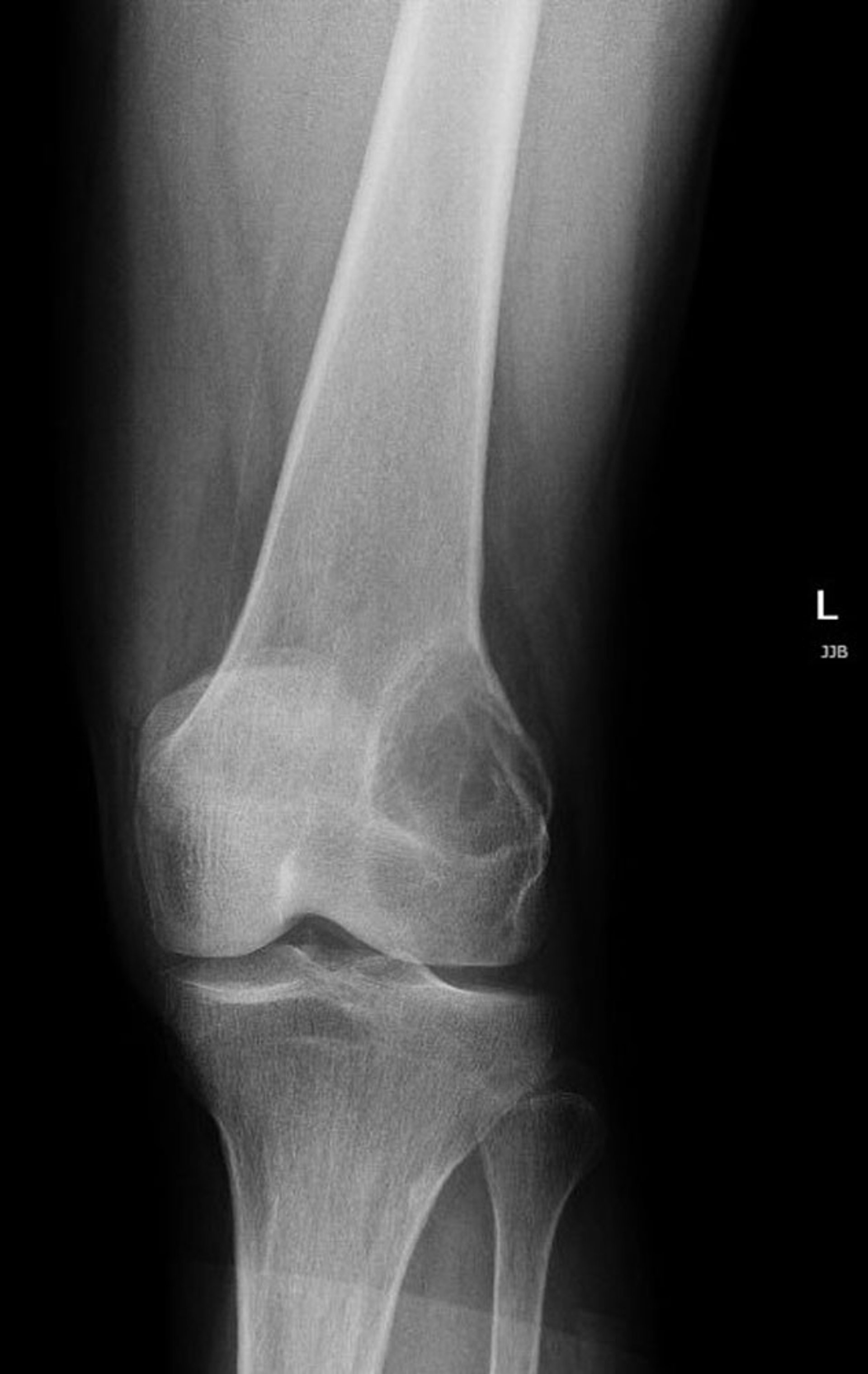 Giant Cell Tumor of Bone