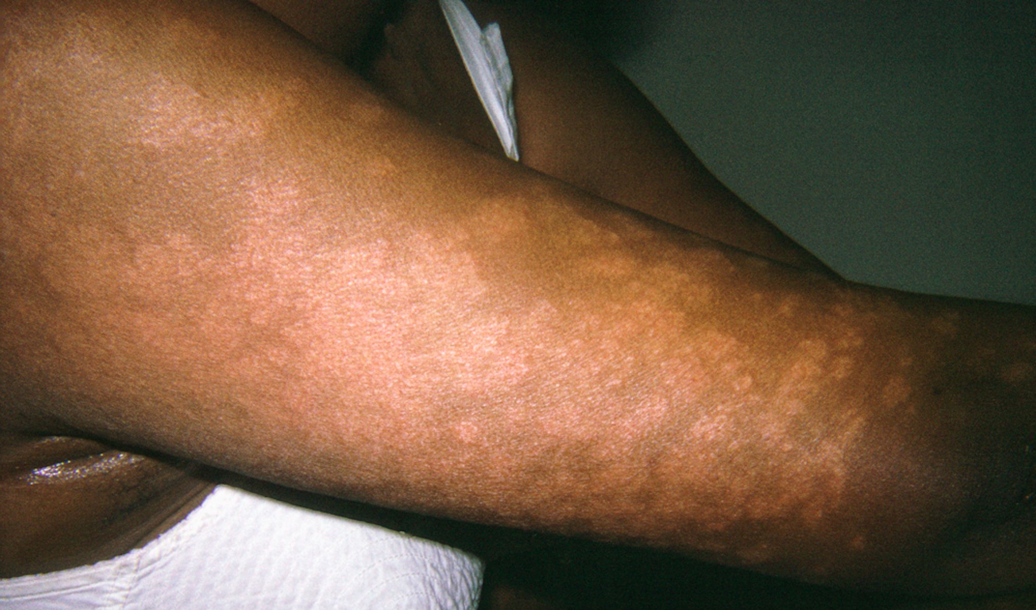 Granuloma anular