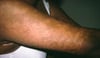 Granuloma anular