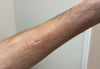 Signo del surco en la fascitis eosinofílica