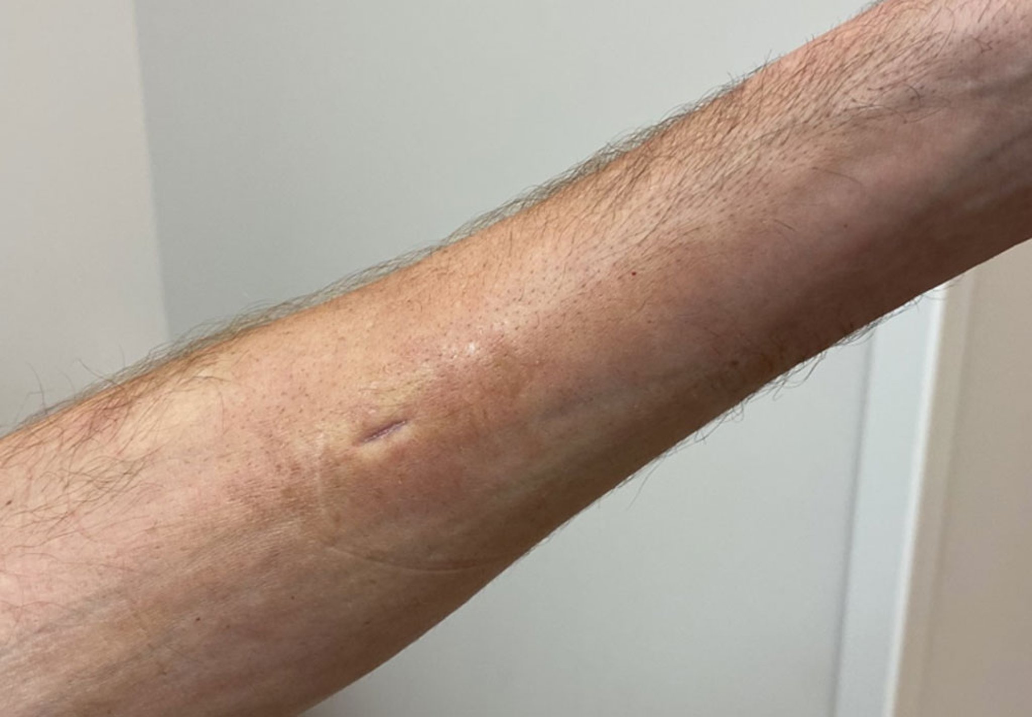 Segno della scanalatura nella fascite eosinofila