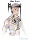 Halo Brace