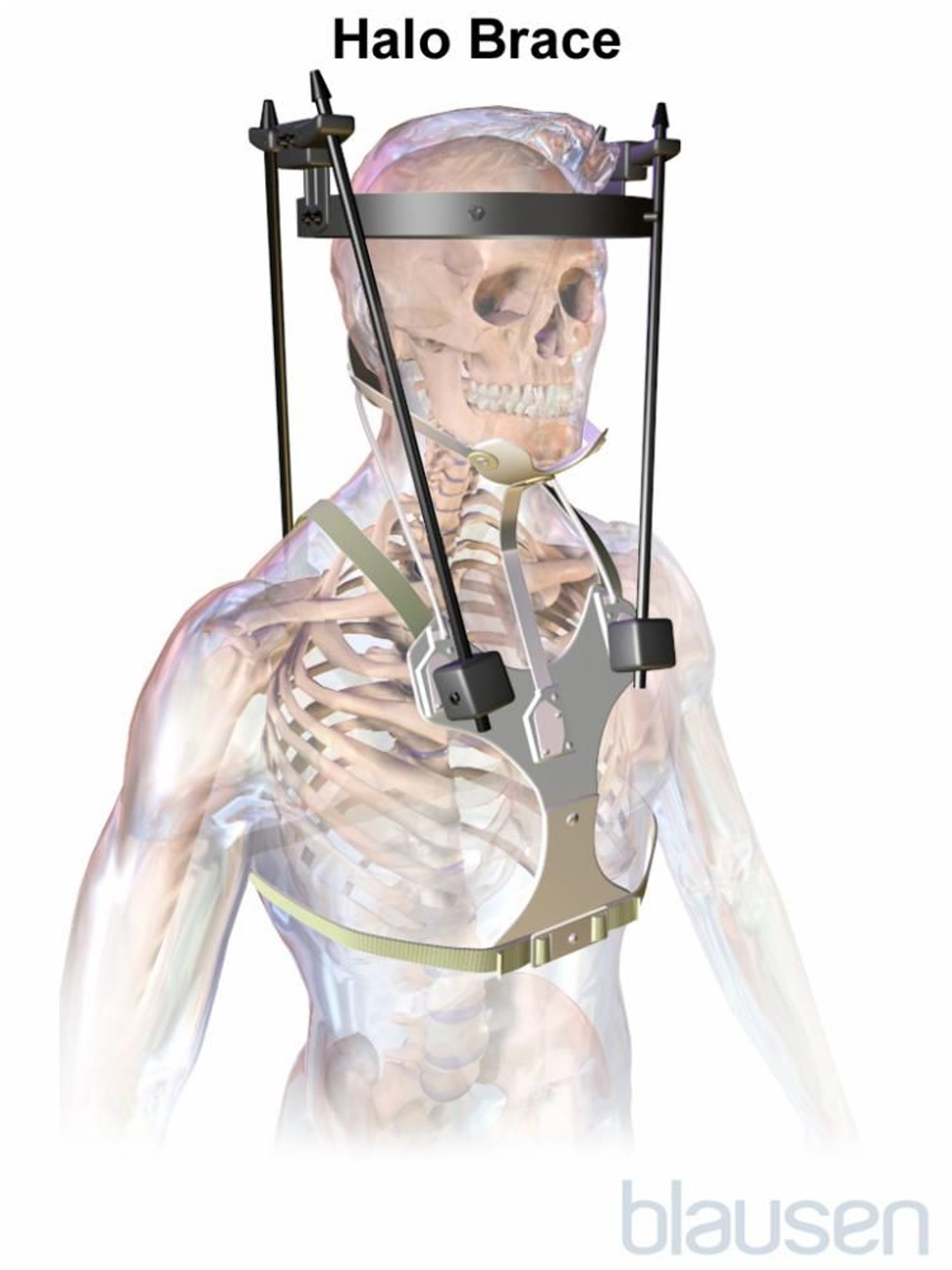 ハローブレース