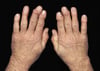 Heberden Nodes