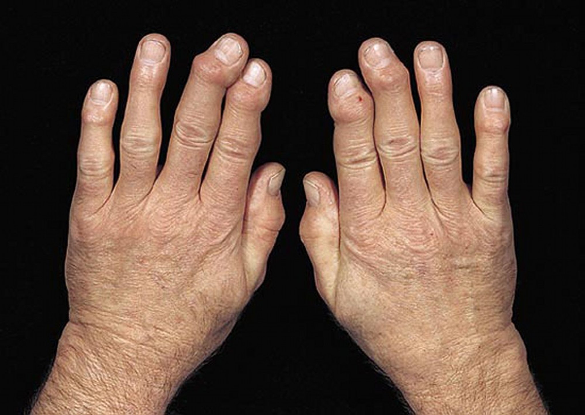 Heberden Nodes