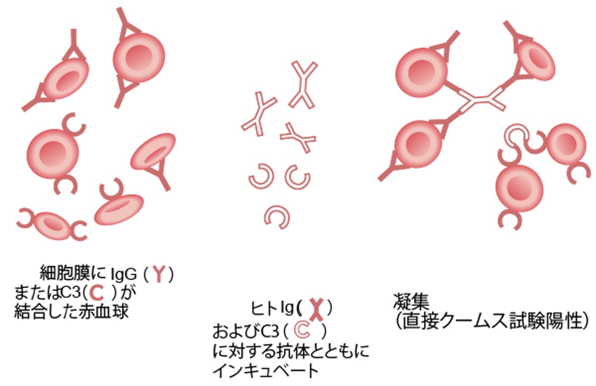 直接抗グロブリン試験（直接クームス試験）