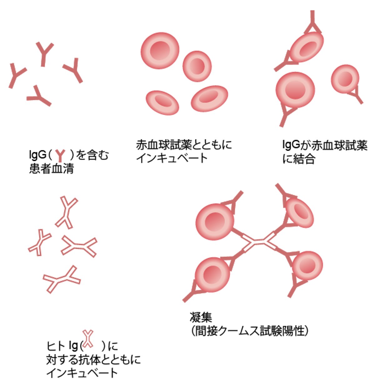 間接抗グロブリン試験（間接クームス試験）