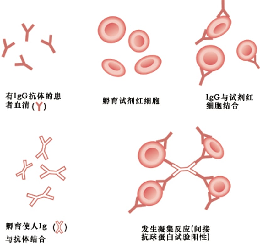 间接抗人球蛋白（间接Coombs）试验